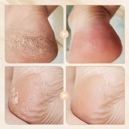 Intenzív regeneráló balzsam repedt sarok és száraz kéz kezelésére